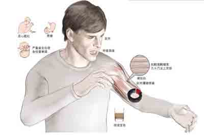 横纹肌溶解综合征