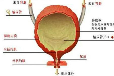 腺性膀胱炎保守治疗