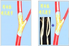 哈欠连天后突然痴呆 阿姨到底患了什么病？