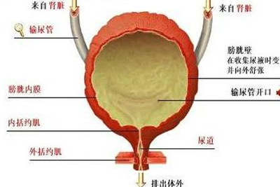 腺性膀胱炎的治疗