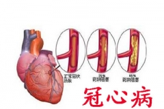 气温骤降 谨防无症状的隐形冠心病