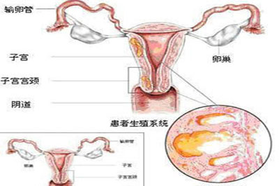 微创介入治疗子宫腺肌症