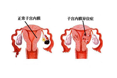 治疗子宫内膜异位症