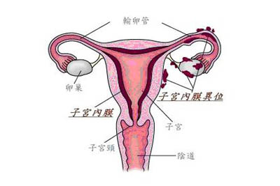 子宫内膜异位症