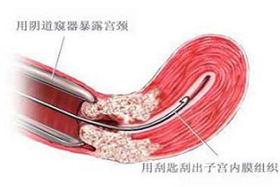 子宫内膜增厚清宫术