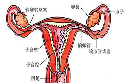 输卵管堵塞治疗方法
