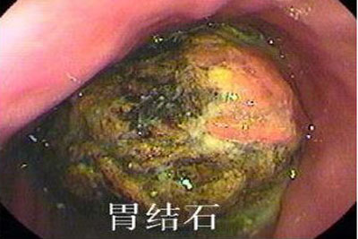 柿石