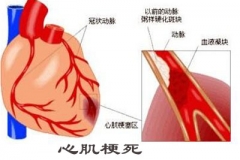 照顾老年痴呆症老伴多年 大爷累出心肌梗死