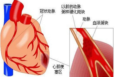 突发急性心梗 
