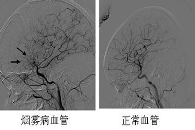 烟雾病
