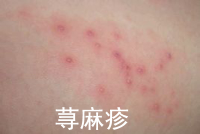 荨麻疹
