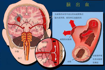 突发脑出血