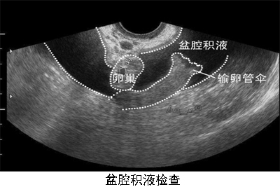 盆腔积液