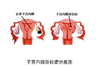 子宫内膜异位症