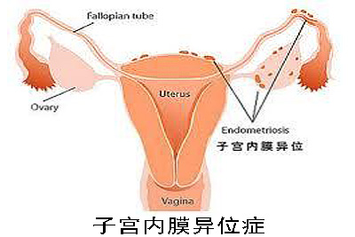 子宫内膜异位症