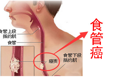 食管癌