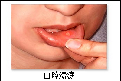 口腔溃疡