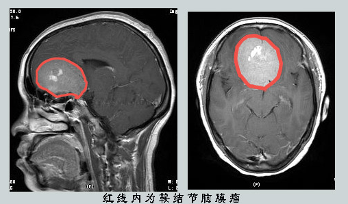 脑膜瘤