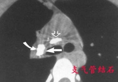 咳着居然吐出了一大脸盆血 原是支气管结石