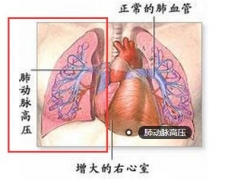 喝了一年半的减肥茶 她患上了肺动脉高压