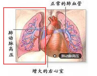 肺动脉高压