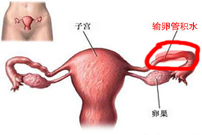 输卵管积水