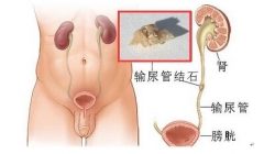 不好生活习惯染上结石病 看看你中了几枪？