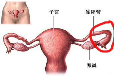 输卵管堵塞