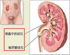生活不规律诱发结石病  预防措施不可少