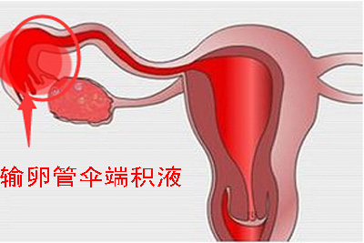 输卵管积液
