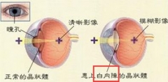 短期内视力下降的厉害 警惕患上白内障
