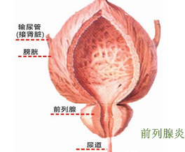 前列腺炎