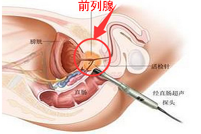 前列腺炎