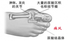 痛风发作擅自吃止痛药 结果成了肾衰竭