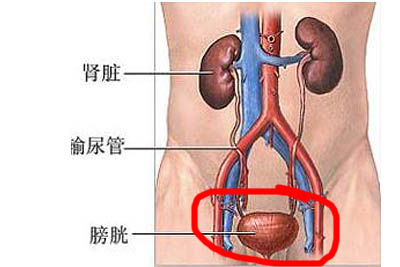 腺性膀胱炎