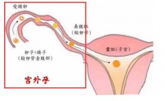 孕妇宫外孕险丧命 四大症状须警惕