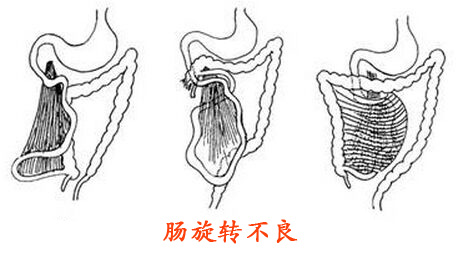 肠旋转不良