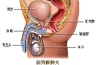 前列腺肿胀