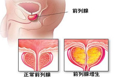 前列腺增生肥大