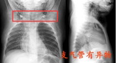 反复出现咳嗽咯痰 元凶是支气管有异物