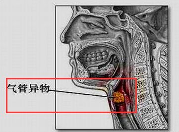 支气管有异物