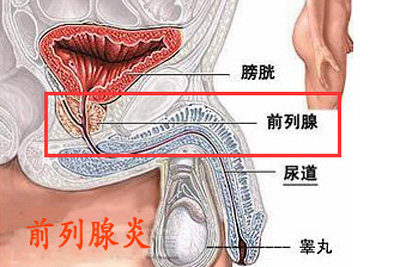 前列腺炎