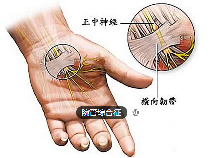腕管综合征