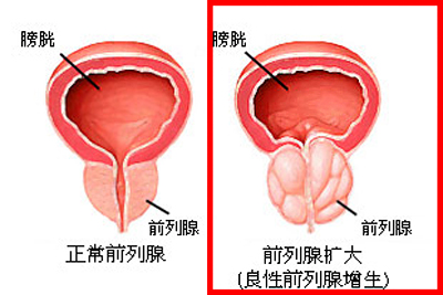 前列腺增生