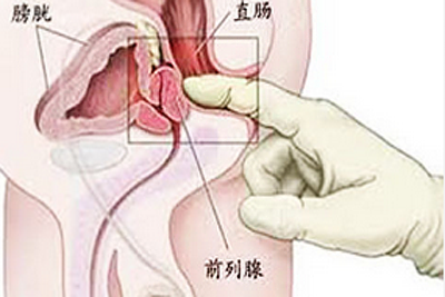 前列腺按摩