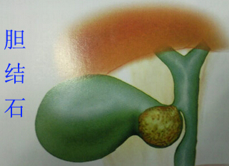 胆结石