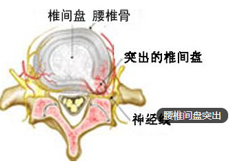 腰椎间盘突出