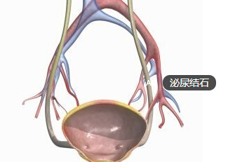 泌尿结石