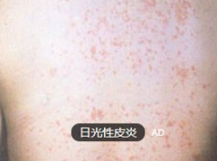 享受日光浴 却晒出日光性皮炎