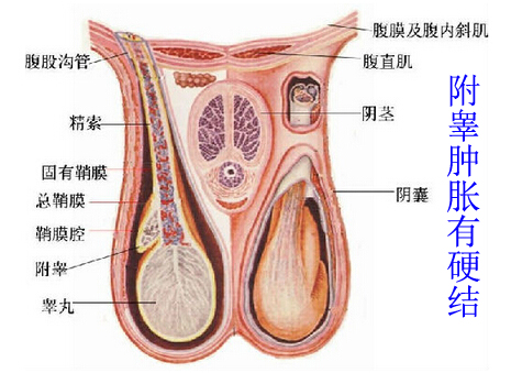 附睾肿胀有硬结